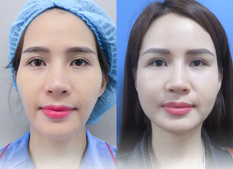 Cấy mỡ mặt hết bao nhiêu tiền ở TP.HCM, Hà Nội và TP.Cần Thơ — khoản chi thực tế là bao nhiêu?