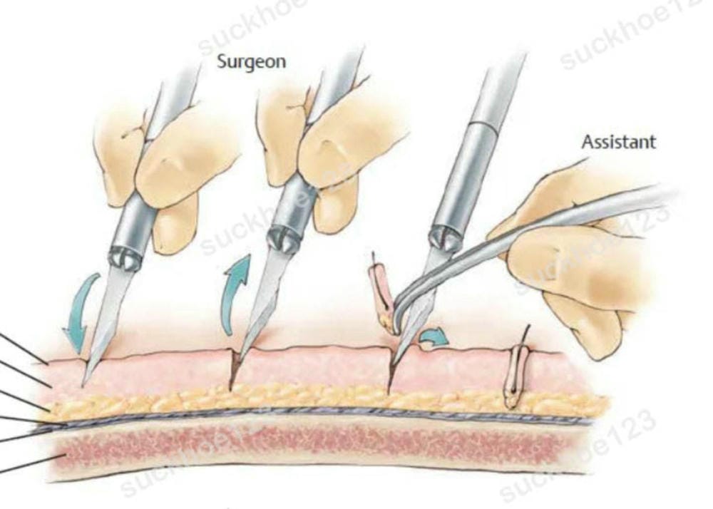 Cấy nang tóc có thực sự phù hợp với trường hợp của bạn?
