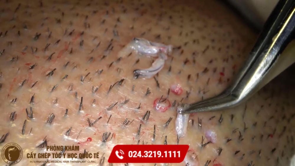 FUE và FUT khác nhau như thế nào — phương pháp nào an toàn hơn?