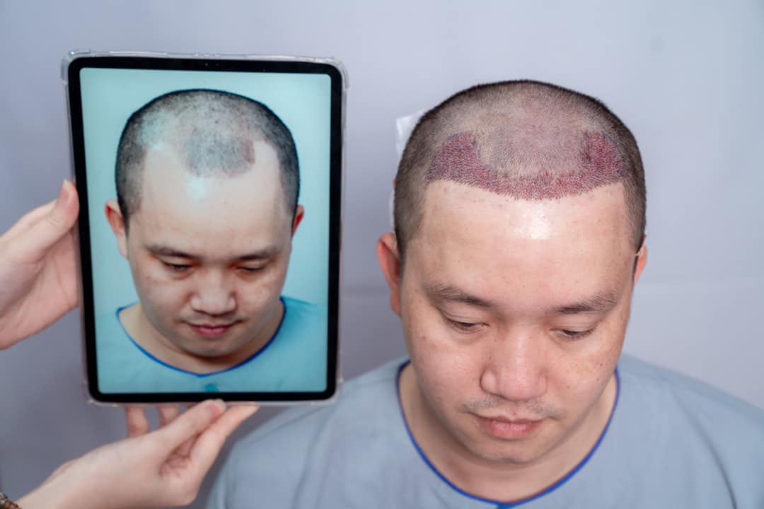 Hói chữ M do rụng tóc androgen — có phải chỉ do di truyền?