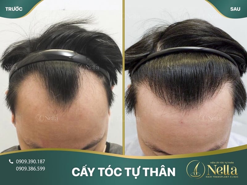 Sau thủ thuật — chăm sóc và tái khám