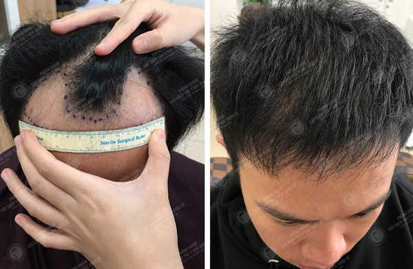 Làm sao để chọn nơi cấy tóc an toàn và cho kết quả tự nhiên?