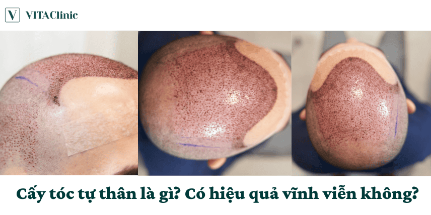 Tại sao một số người vẫn thấy tóc rụng sau vài năm dù đã cấy?