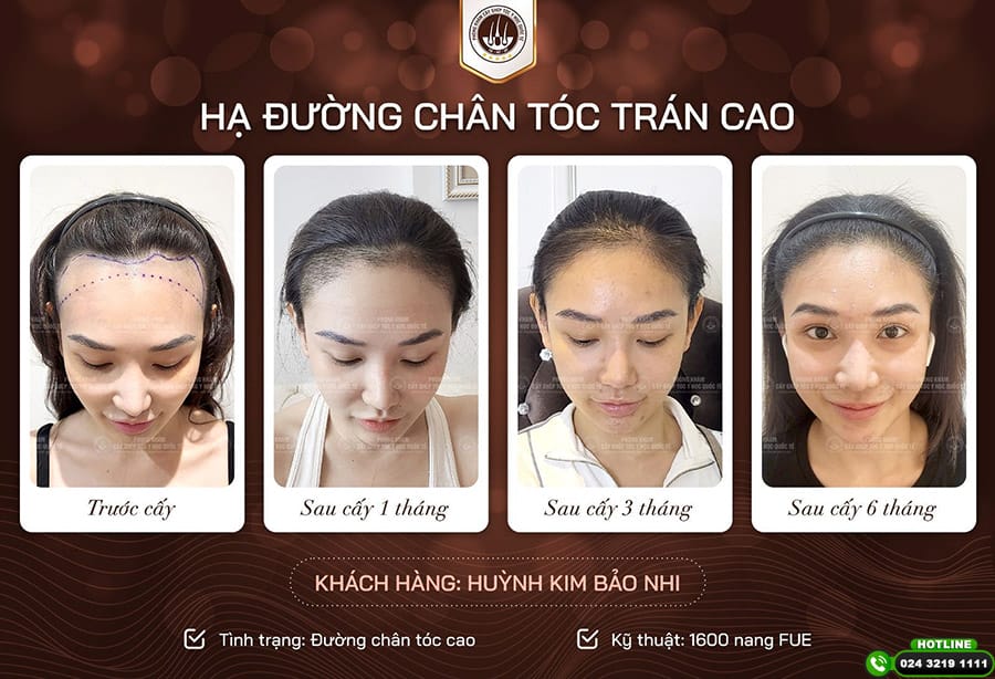 Ai là ứng viên phù hợp và ai cần thận trọng?