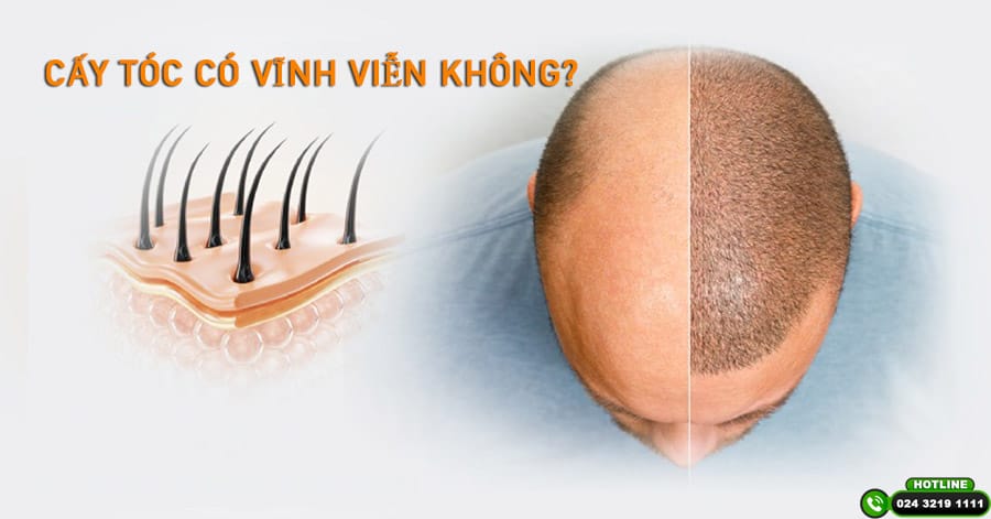 Bằng chứng lâm sàng: tỉ lệ sống của graft và thành công thực tế là bao nhiêu?