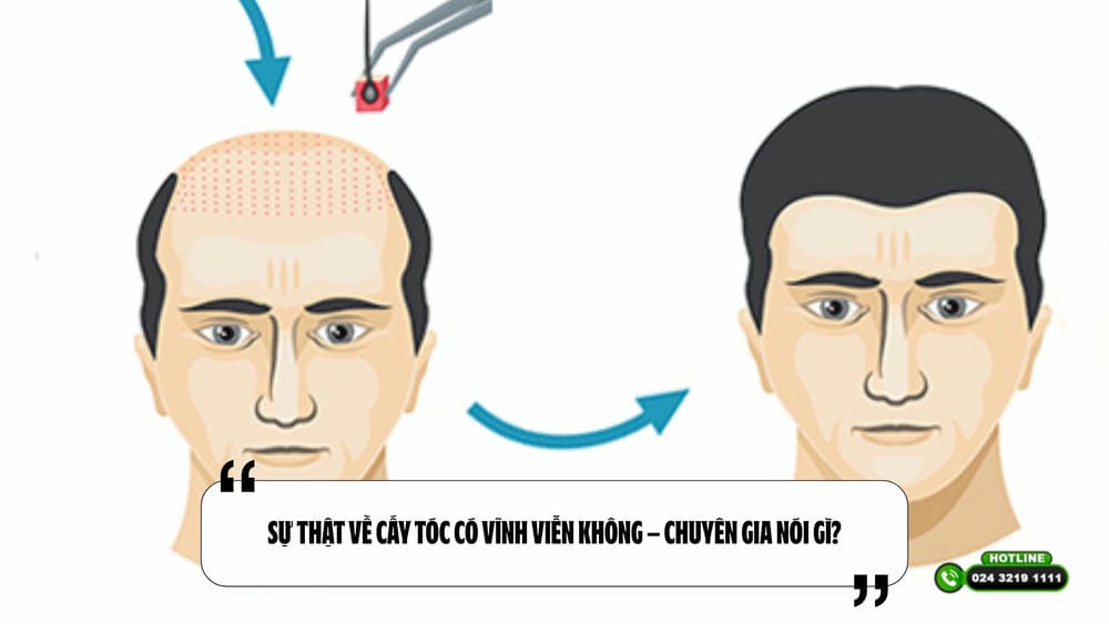 Cấy tóc có thể cần làm lại không và chi phí duy trì ra sao?