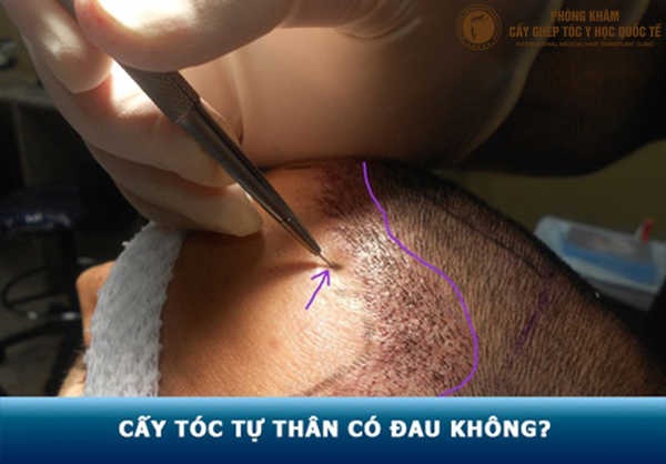 Cấy tóc có đau không — cảm giác trong khi thực hiện như thế nào?