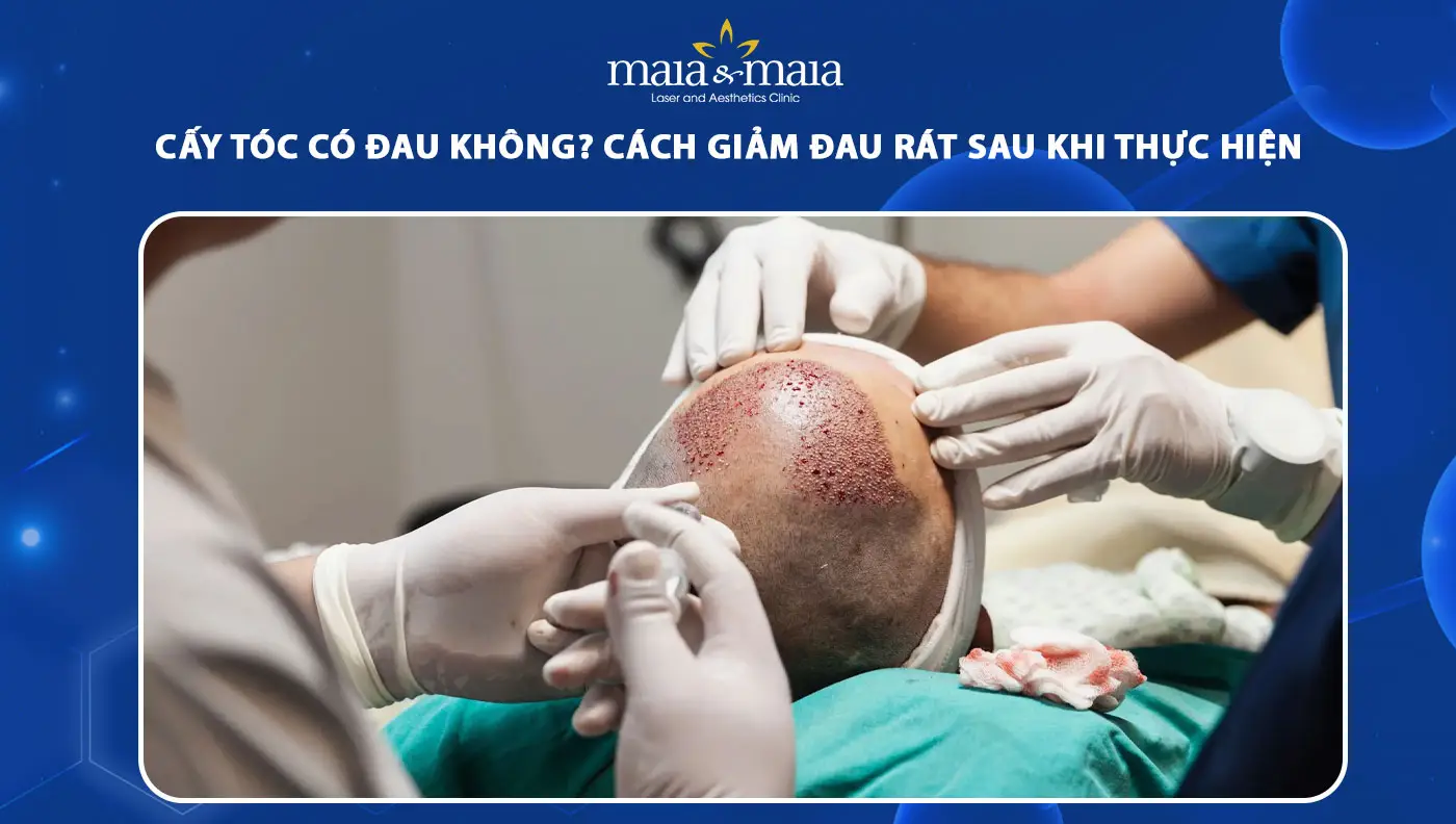 Đau sau khi cấy tóc kéo dài bao lâu và khi nào cần lo lắng?