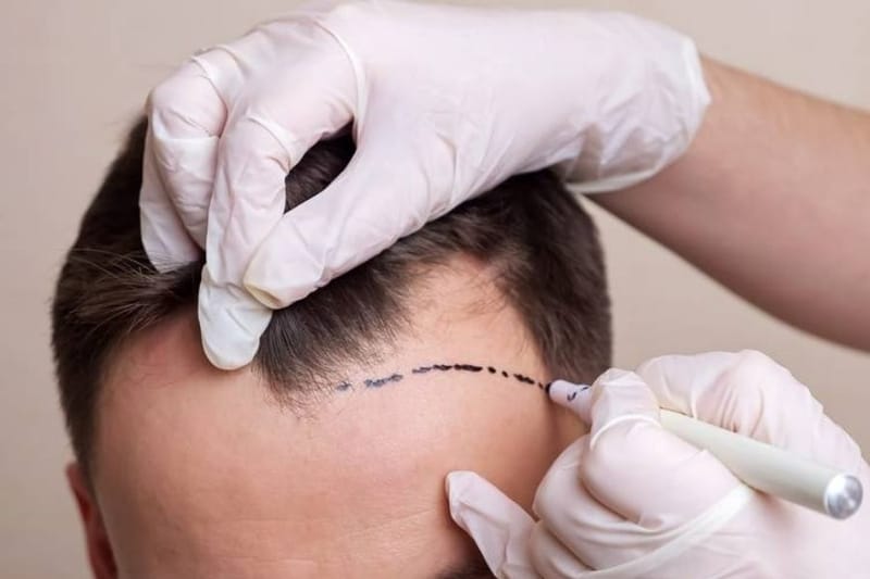 Làm thế nào để giảm đau trước, trong và sau cấy tóc — và chăm sóc sau cấy tóc?