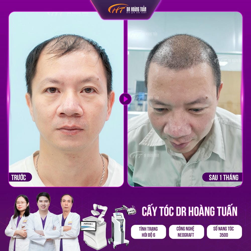 Nếu lo sợ đau — có lựa chọn nào ít xâm lấn hơn để thử trước khi cấy?