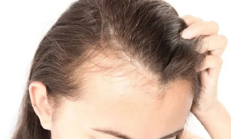 Cấy tóc kết hợp liệu pháp hỗ trợ
