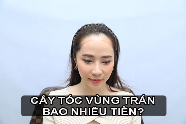 Tại sao vùng trán thường khác giá so với đỉnh đầu?