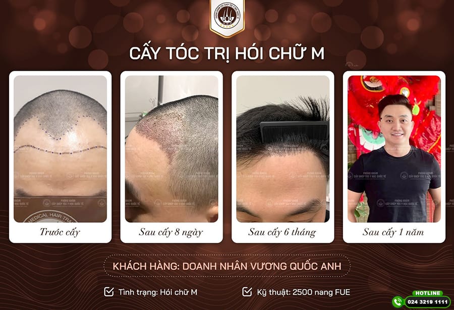 3) Bao lâu cần điều trị hỗ trợ nội khoa?