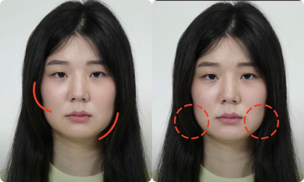 2) Tiêm filler tạo dáng cằm (non-surgical augmentation)