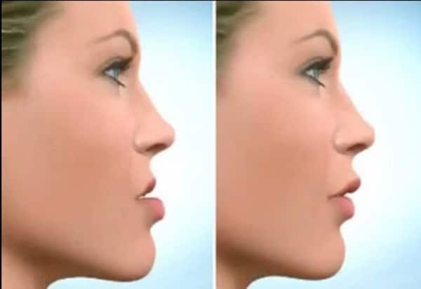 Quy trình phẫu thuật gọt cằm / chỉnh hàm — các bước tuần tự