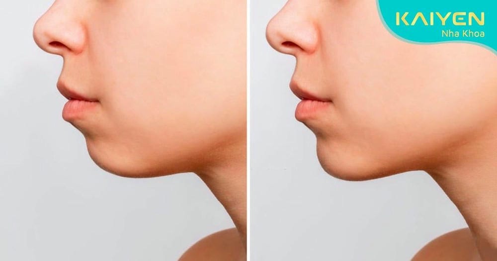 Nguyên nhân nào khiến cằm bị lẹm — do xương, mô mềm hay thói quen?
