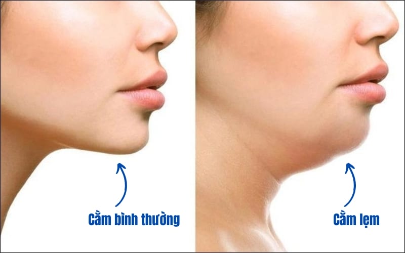 Chất làm đầy kích thích sinh học (biostimulators) và lựa chọn cho cằm