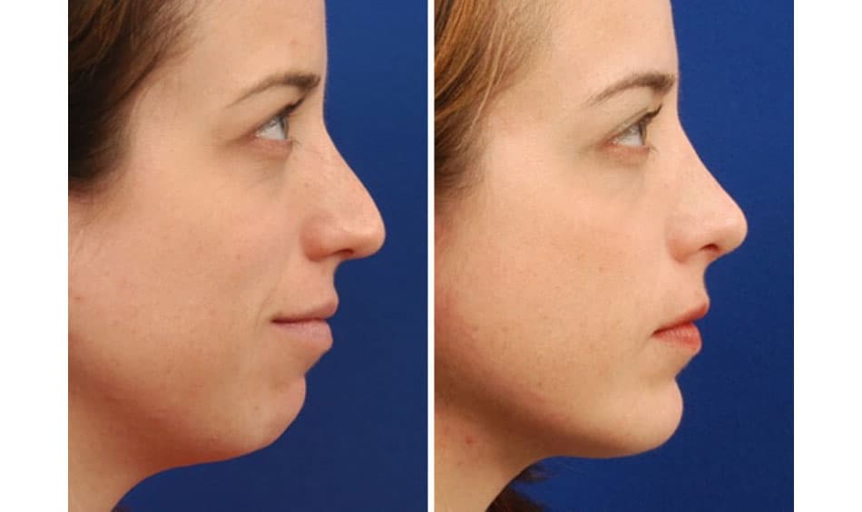 Quy trình điều trị cằm lẹm bằng tiêm filler — chuẩn bị, thực hiện và chăm sóc sau thủ thuật?
