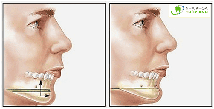 So sánh nhanh: Tiêm filler vs. Biostimulators vs. Phẫu thuật — chọn thế nào cho đúng?