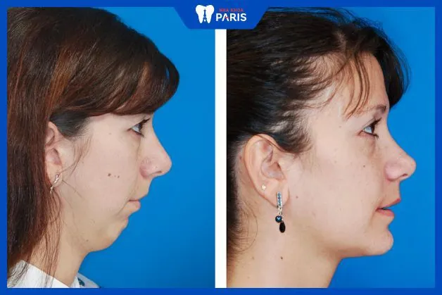 Làm sao để chọn nơi điều trị uy tín và an toàn cho cằm lẹm?