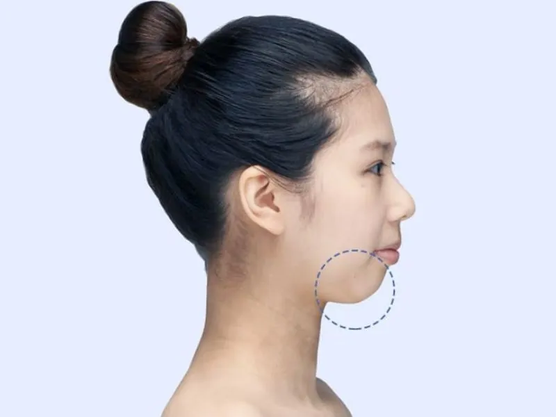 Phương pháp làm dài cằm hiện có — filler cằm, độn cằm hay chỉnh xương cằm?