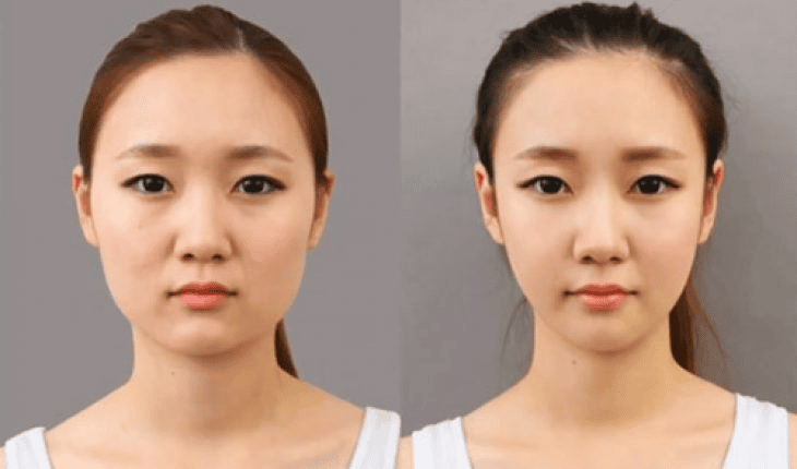 So sánh nhanh: filler HA, CaHA, PLLA và phẫu thuật — ưu nhược điểm theo mục tiêu