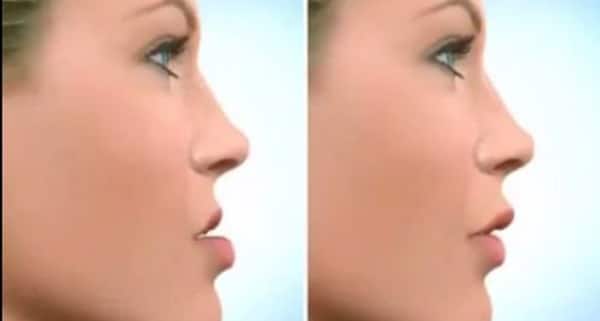 Tiêm filler cằm có hiệu quả thế nào và loại filler nào được ưu tiên?