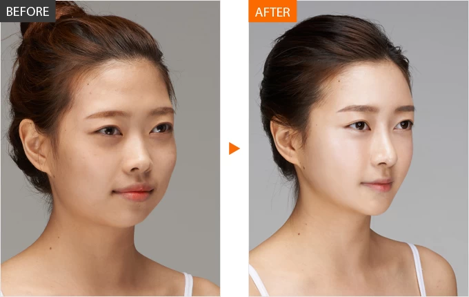 Liệu có bằng chứng lâm sàng ủng hộ dùng filler hoặc CaHA cho cằm?