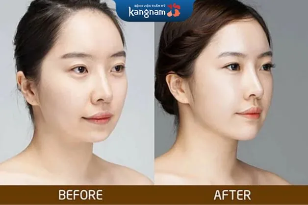 Botox (tiêm botulinum toxin vùng cắn) có giúp cằm gọn không?