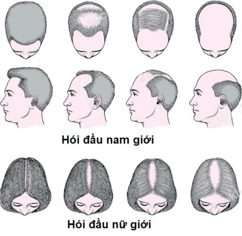 Phân biệt nguyên nhân — rụng tóc di truyền và các dạng khác thường gặp
