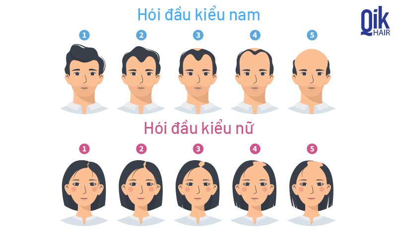 Khi nào cân nhắc cấy tóc — và cần lưu ý gì trước khi quyết định?