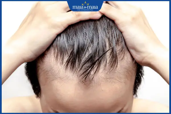 Nguyên nhân chính khiến đàn ông bị hói là gì — có phải do di truyền hoàn toàn không?