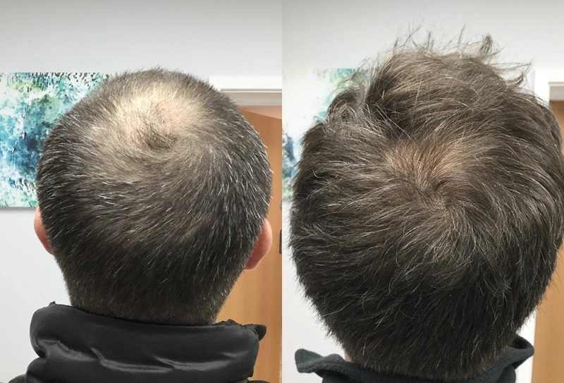 So sánh nhanh: minoxidil vs finasteride