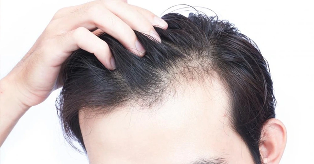 Khi nào nên cân nhắc cấy tóc và quy trình cấy tóc bao gồm những bước nào?
