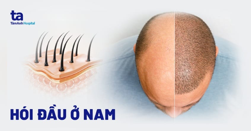 Rủi ro và kỳ vọng thực tế sau cấy tóc