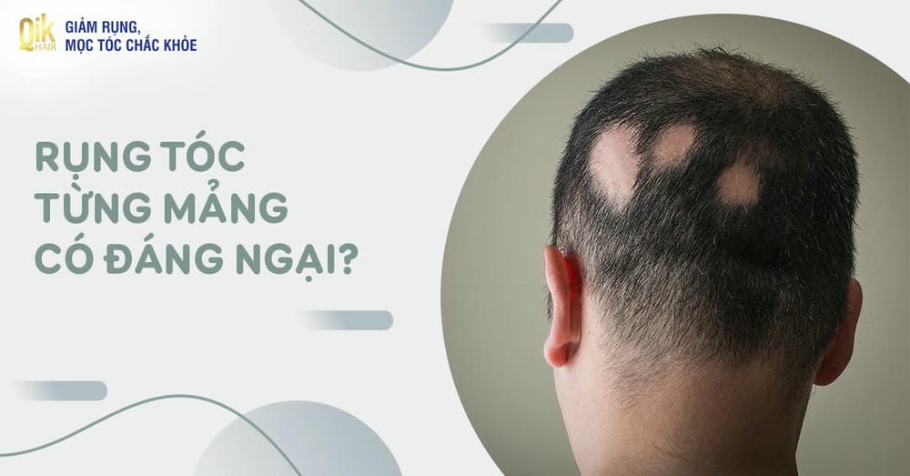 Điều trị rụng tóc: bằng chứng và rủi ro cần biết