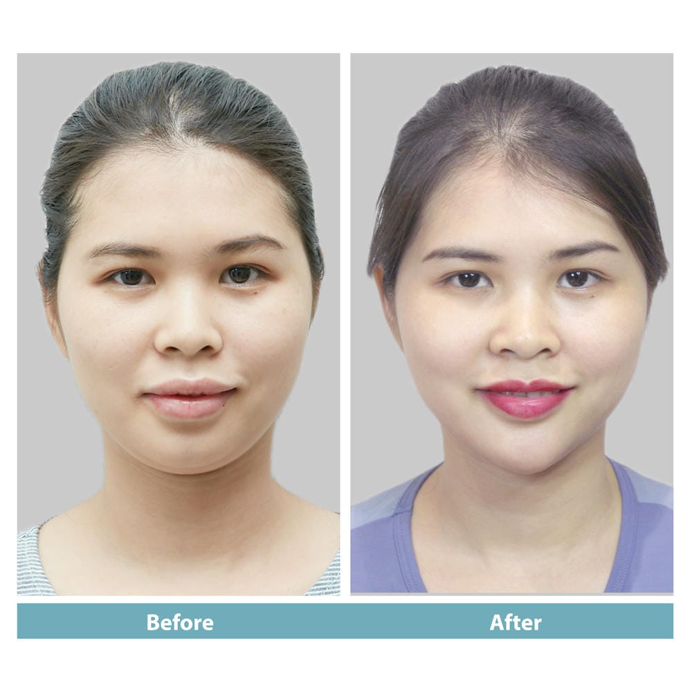 Filler cằm hoạt động thế nào và giữ được bao lâu?