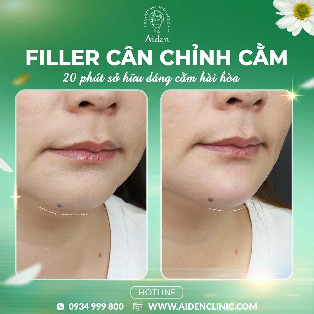 Quy trình tiêm filler cằm an toàn: chuẩn trước, trong và sau thủ thuật?