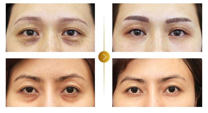 Làm thế nào để phân biệt filler chính hãng và hàng nhái?