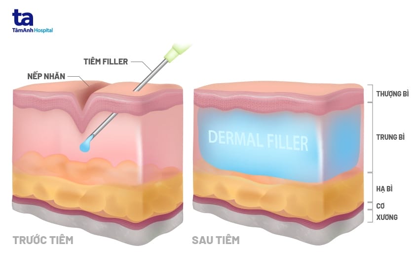Cơ chế tác dụng khi đặt filler ở trung bì/hạ bì