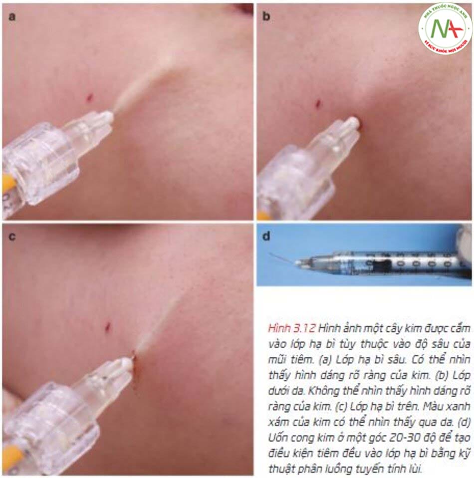 Những rủi ro thường gặp khi tiêm vào trung bì/hạ bì