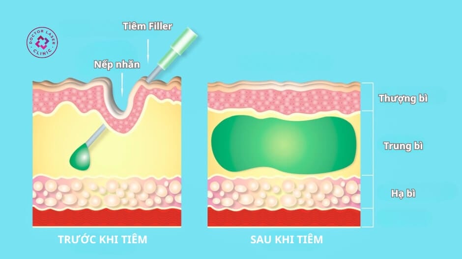 Những câu hỏi khách hàng thường đặt: hiệu quả kéo dài bao lâu và có thể chỉnh sửa không?