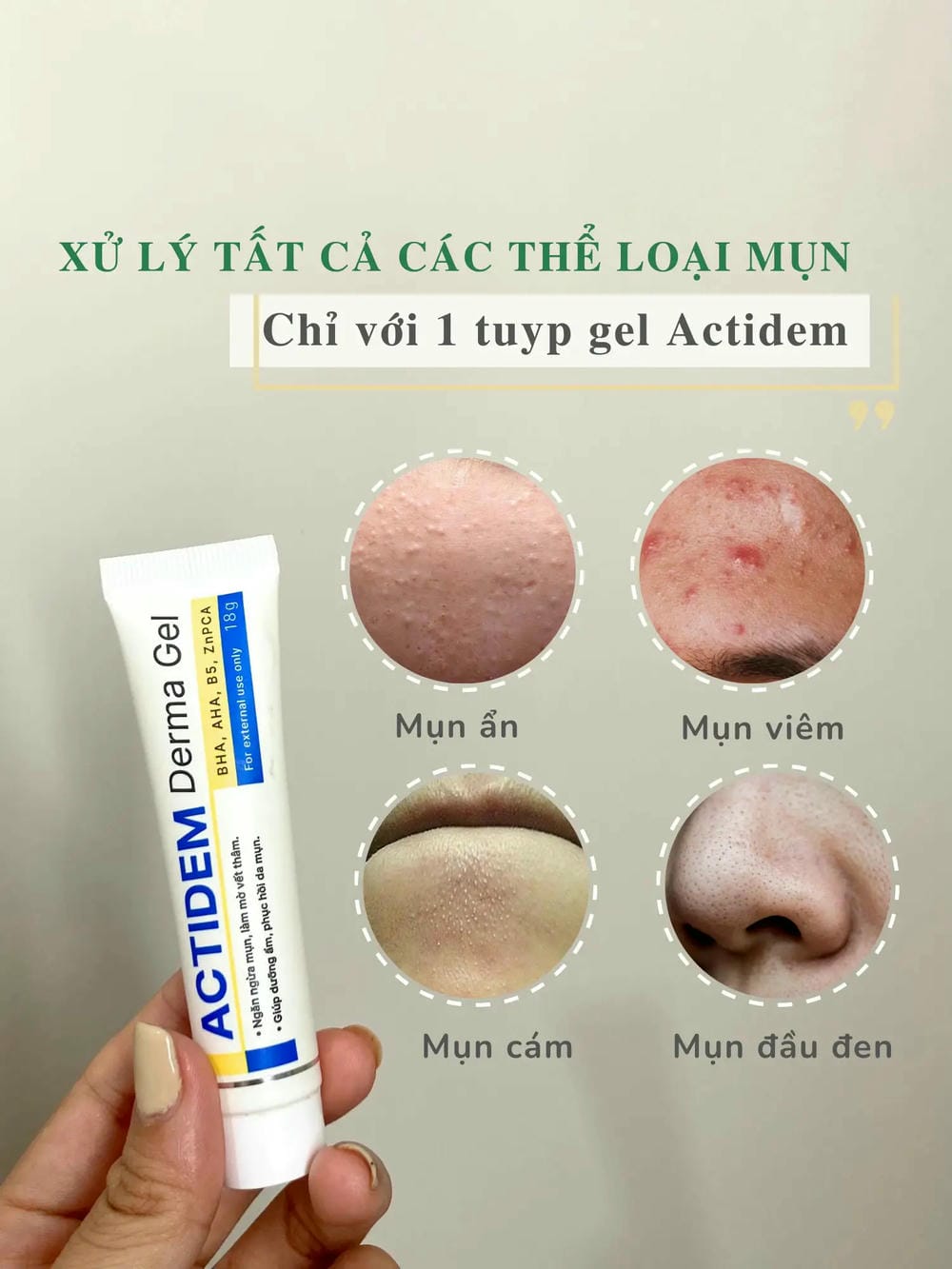 Ai phù hợp dùng Gel chấm mụn Actidem — và ai không nên dùng?