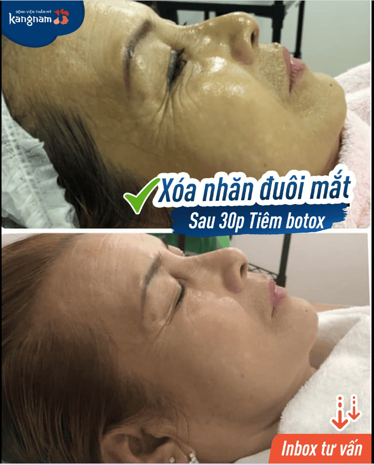 Bằng chứng lâm sàng: Tiêm botox cho nếp cau mày có an toàn không?