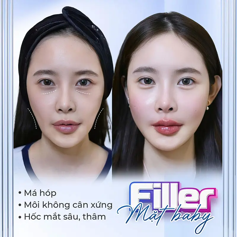Quy trình tiêm filler má an toàn tại một clinic chuẩn y tế là như thế nào?