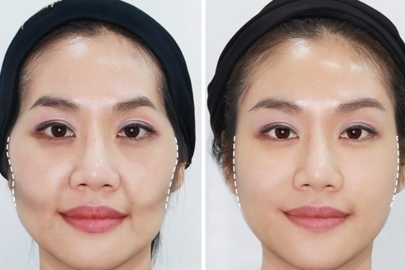 Làm sao để chọn nơi tiêm filler má uy tín — những tiêu chí cần kiểm tra?