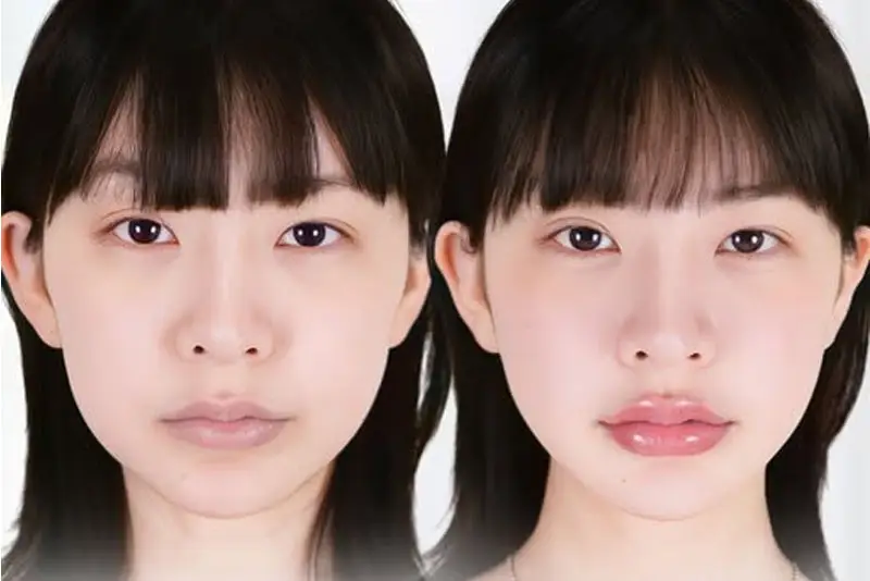 Filler môi giữ được bao lâu và yếu tố ảnh hưởng?