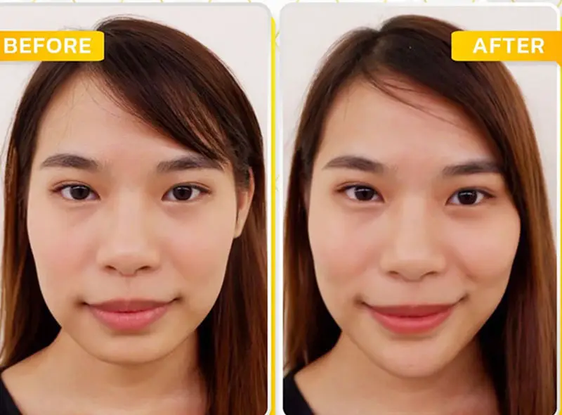 So sánh: Tiêm filler vùng mắt và phương pháp phẫu thuật (fat repositioning / blepharoplasty) — chọn gì cho trường hợp của mình?