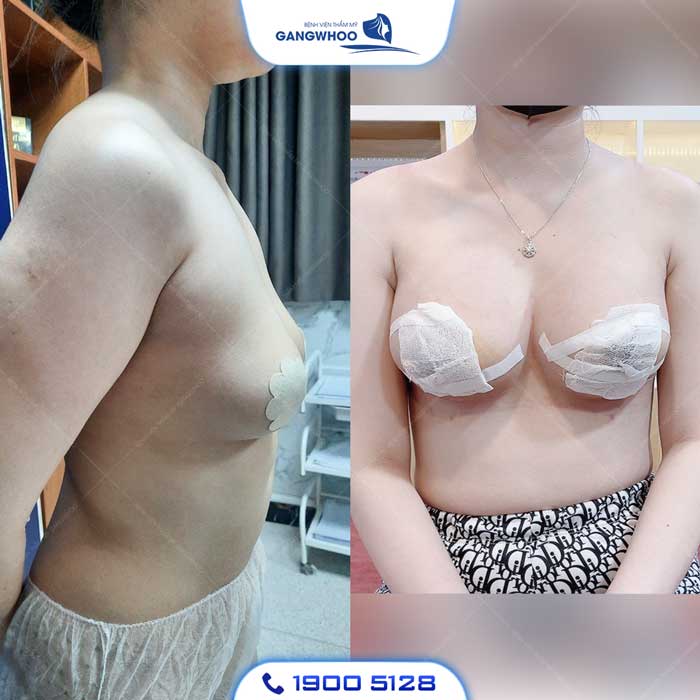 So sánh: Tiêm filler ngực vs cấy mỡ tự thân vs nâng ngực đặt túi — ưu nhược điểm?