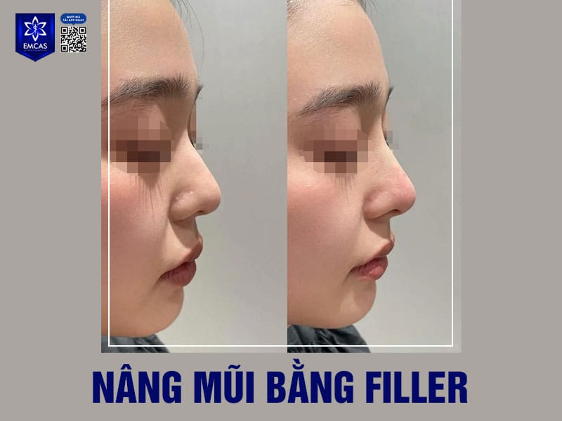 Các phương pháp phối hợp để có kết quả nâng mũi tự nhiên hơn — khi nào nên kết hợp?